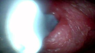 Endoscope Camera Records Male Ejaculation in Outdoor Hospital Setting